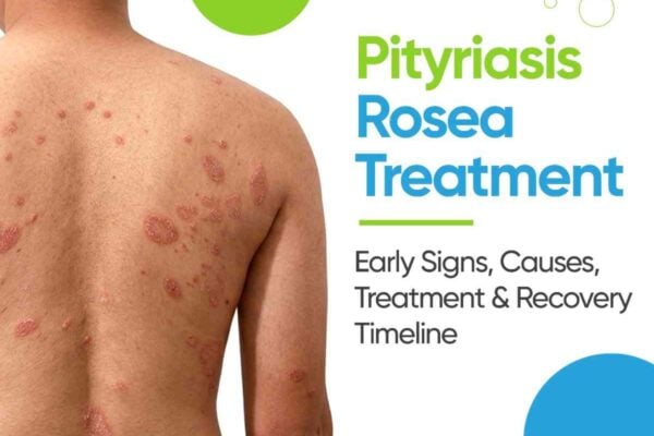 pityriasis