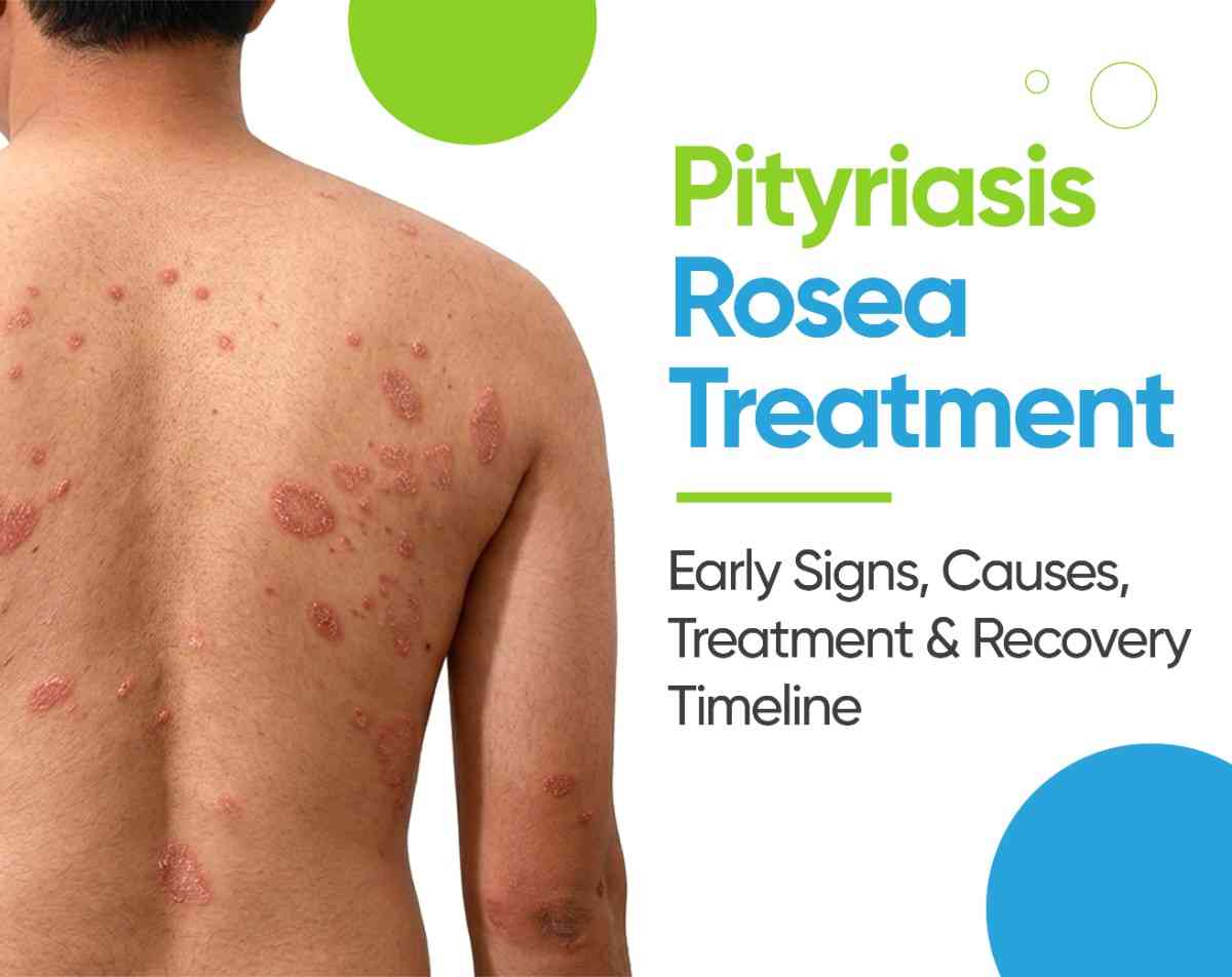 pityriasis