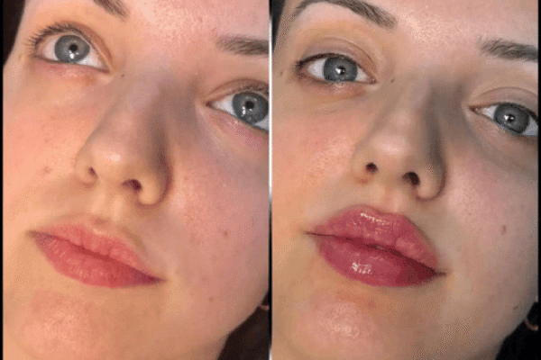 Fillers in Dubai