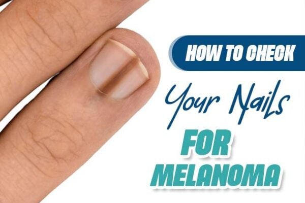 melanoma of the nails