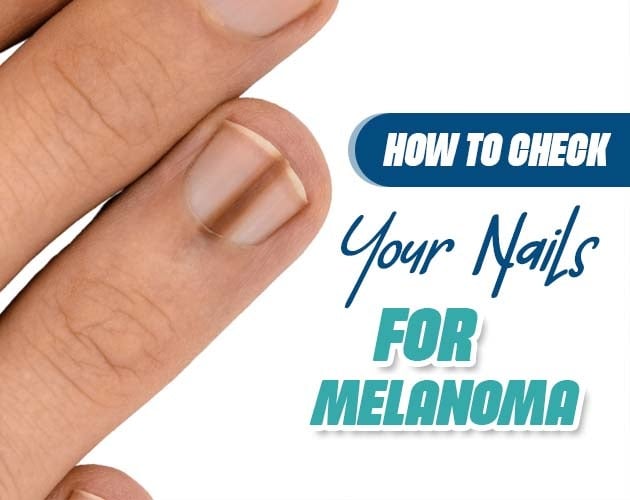 melanoma of the nails