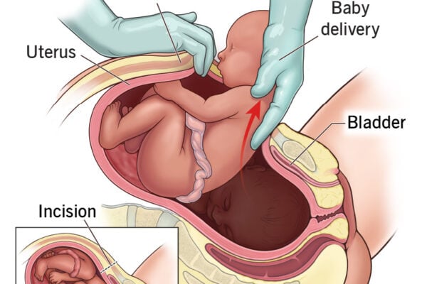 cesarean section surgery
