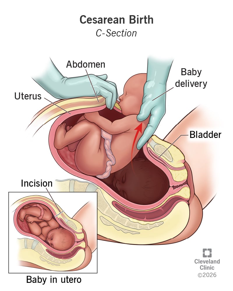 cesarean section surgery