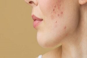 Acne Treatment in Riyad