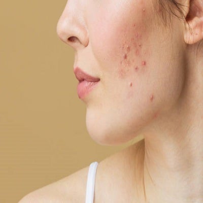 Acne Treatment in Riyad
