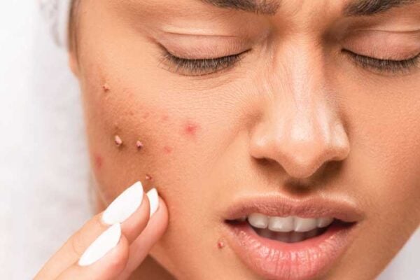 acne scar treatment in Dubai