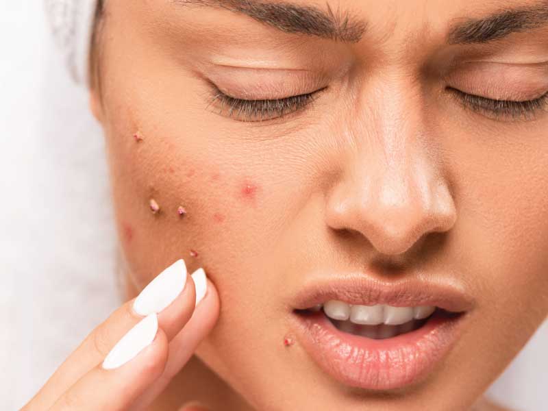 acne scar treatment in Dubai