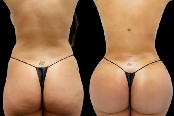 fat transfer cost in dubai