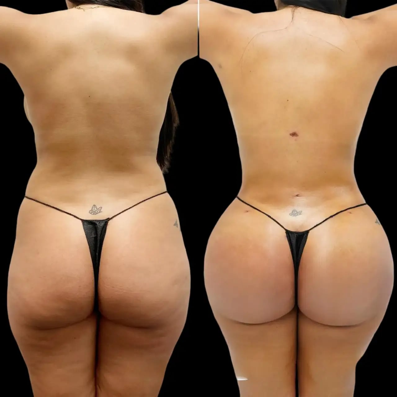 fat transfer cost in dubai