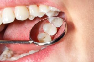 Dental Fillings