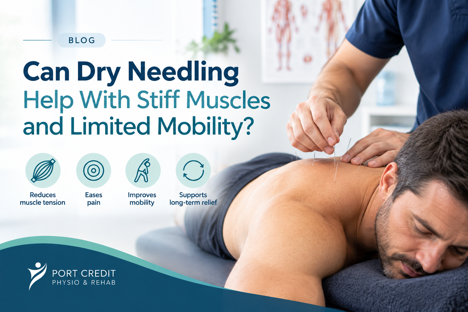 Can Dry Needling Help With Stiff Muscles and Limited Mobility?