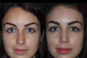 Septoplasty in Dubai