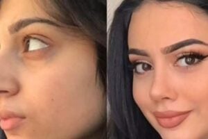 Rhinoplasty in Dubai