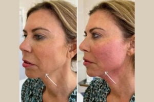 Best Plastic Surgeons in dubai for Next-Generation Endolift Treatments