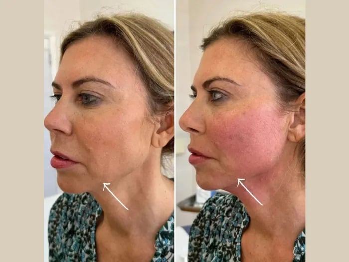Best Plastic Surgeons in dubai for Next-Generation Endolift Treatments