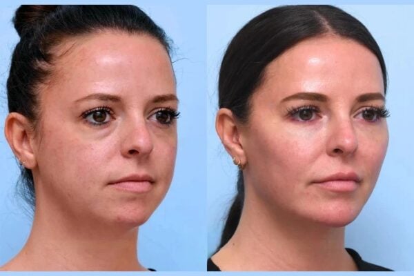 Thread Lift in Dubai to Refresh Tired and Aging Facial Features