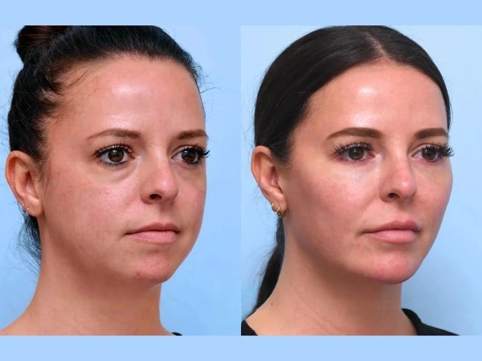 Thread Lift in Dubai to Refresh Tired and Aging Facial Features