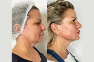 Endolift treatments in Dubai for Improved Jawline Definition