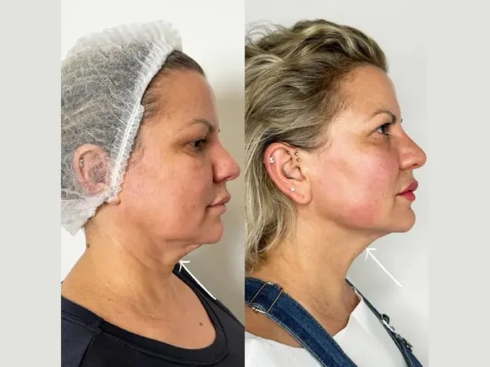 Endolift treatments in Dubai for Improved Jawline Definition