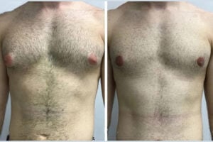 Gynecomastia in Dubai