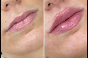 Dermal Fillers in Dubai