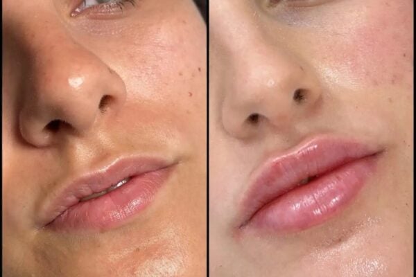 Fillers in Dubai