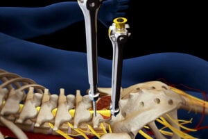 Herniated Disc Surgery in Mesquite