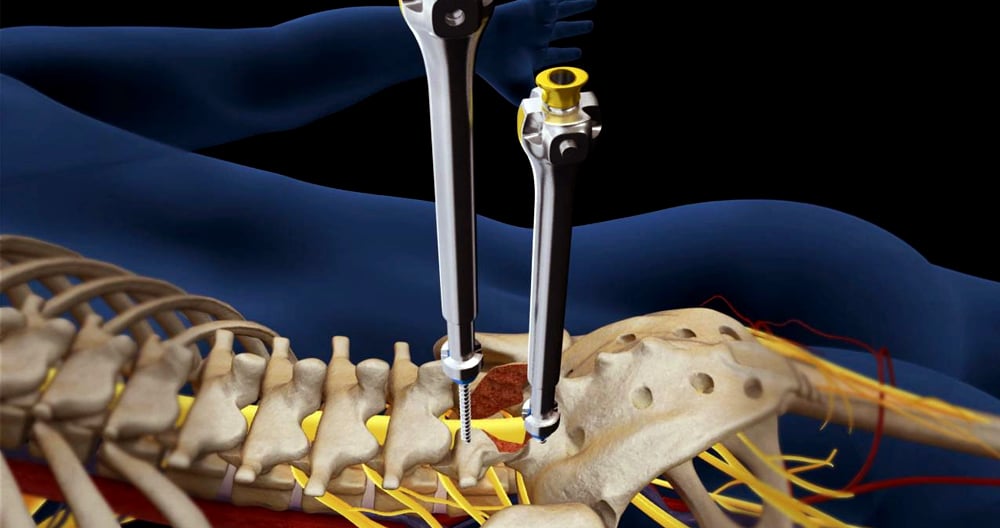 Herniated Disc Surgery in Mesquite