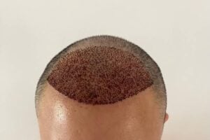 How does DHI Hair Transplant differ from other techniques