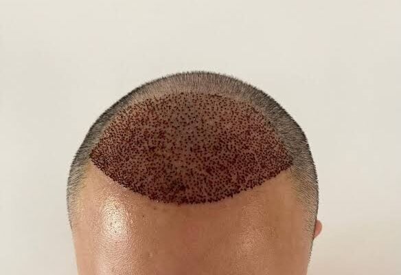 How does DHI Hair Transplant differ from other techniques