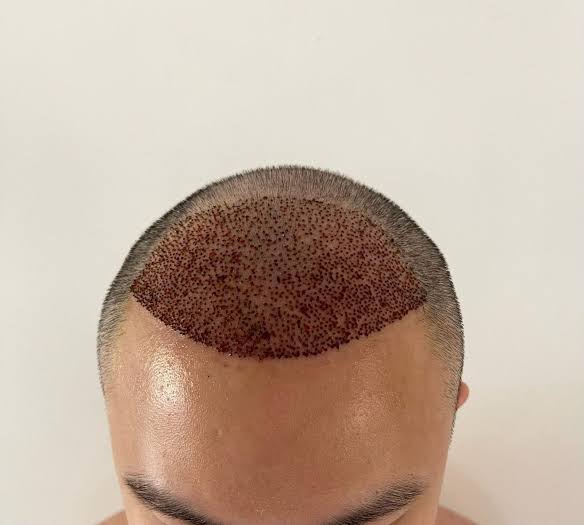 How does DHI Hair Transplant differ from other techniques