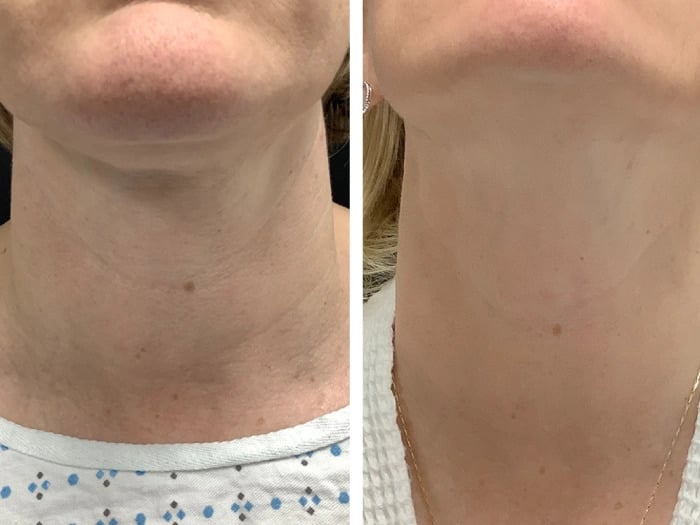 Radiofrequency (RF) Microneedling treatments in Dubai for Acne Scar Appearance