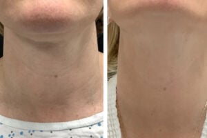 Best Plastic Surgeons in dubai for Modern RF Microneedling Rejuvenation
