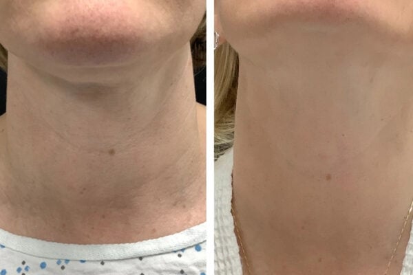 Best Plastic Surgeons in dubai for Modern RF Microneedling Rejuvenation