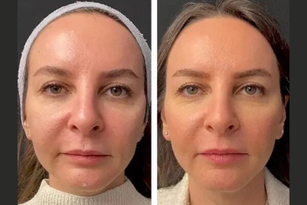 Mesotherapy in Dubai
