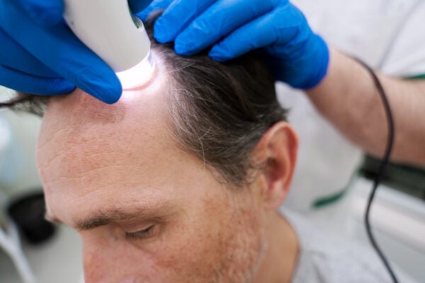 Man undergoing hair loss treatment