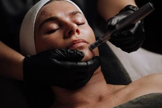 What Can Microneedling Treatment for Pores