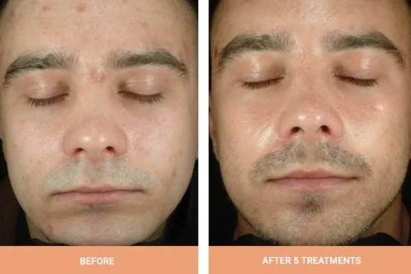 Photodynamic Therapy Actinic Keratosis treatment procedure and skin recovery