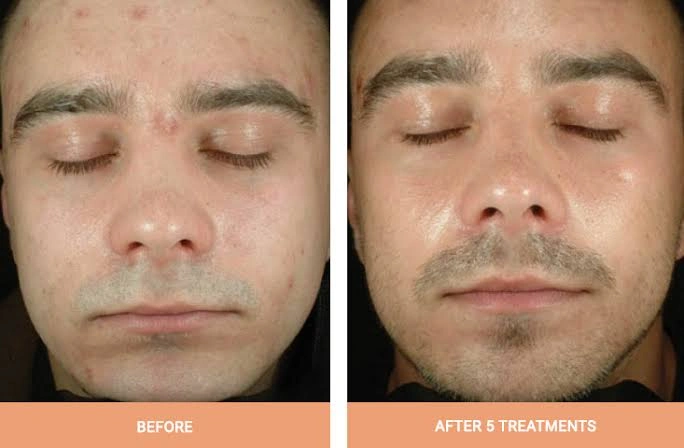 Photodynamic Therapy Actinic Keratosis treatment procedure and skin recovery