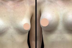 Breast augmentation in dubai