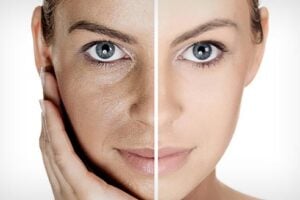 face rejuvenation