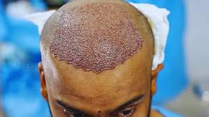 hair loss treatment London