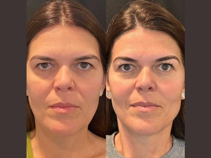 Best Aesthetic Clinic in Dubai for Expert Thread Lift and Youthful Skin