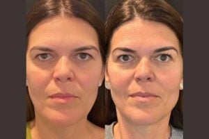 Best Aesthetic Clinic in Dubai for Modern Thread Lift Rejuvenation and Youthful Results