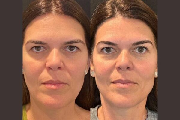 Best Aesthetic Clinic in Dubai for Modern Thread Lift Rejuvenation and Youthful Results