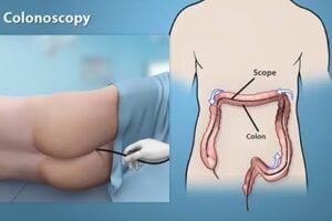 best colonoscopy hospital in guwahati