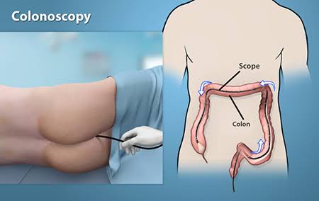 best colonoscopy hospital in guwahati