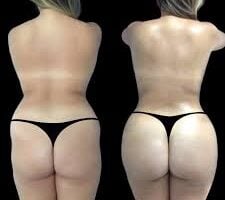 butt fat transfer in dubai