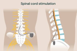 spinal cord stimulation Al Ain