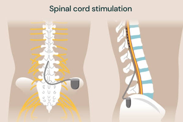 spinal cord stimulation Al Ain